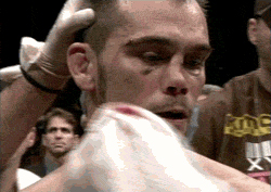 Rich Franklin broken nose